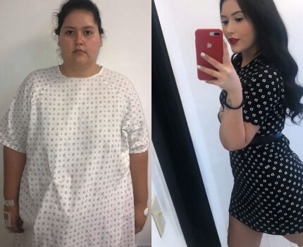 1 year post op