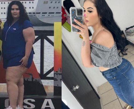 1 year post op