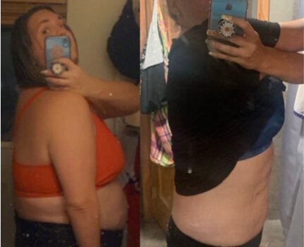1 year post op